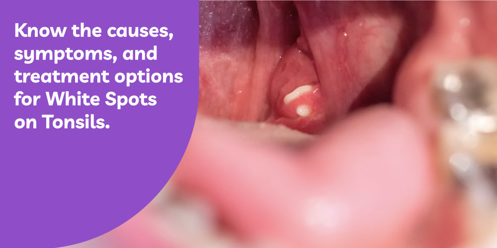 White Spots on the Tonsils